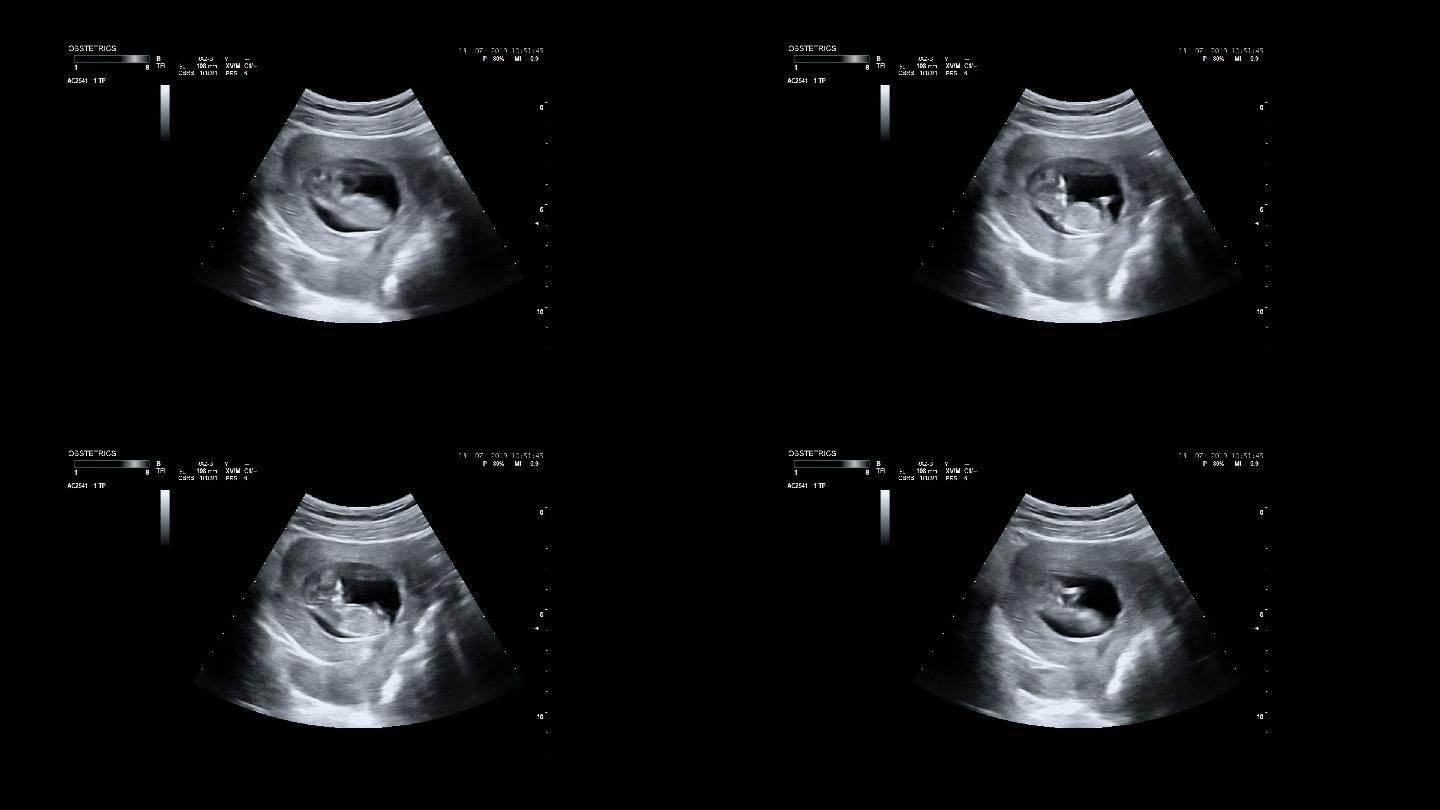 孕妇的超声波检查。