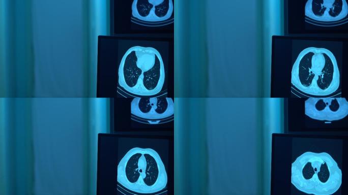肺部扫描