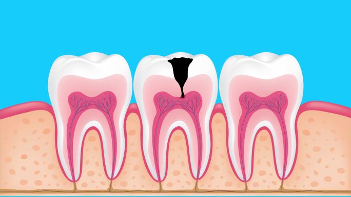 龋齿发展阶段。牙疼坏牙牙科牙髓炎