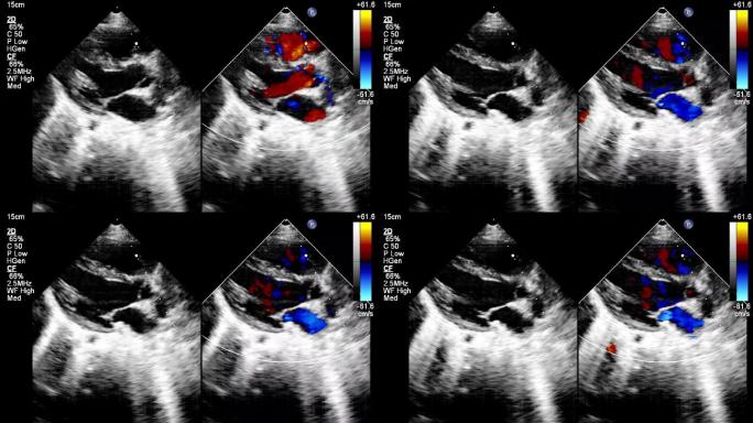 带有心脏图像的超声波机屏幕。