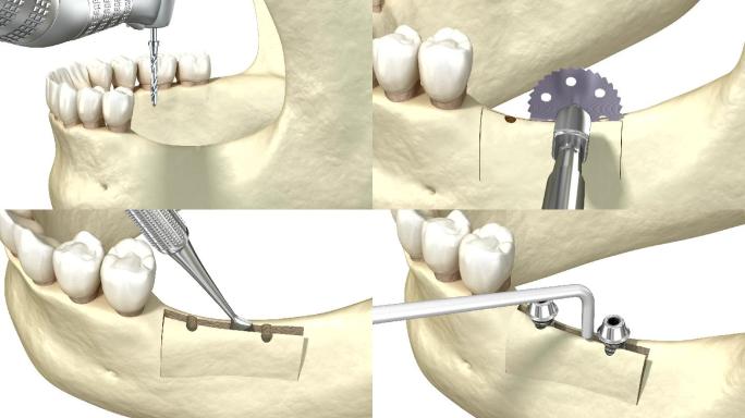 牙槽嵴裂开，增大，植入。