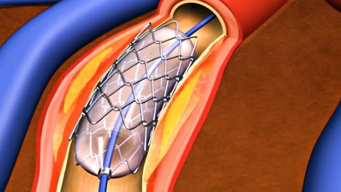 介入心脏支架手术动画视频素材