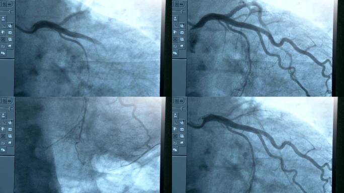 临床血管造影术中显示的静脉和动脉搏动