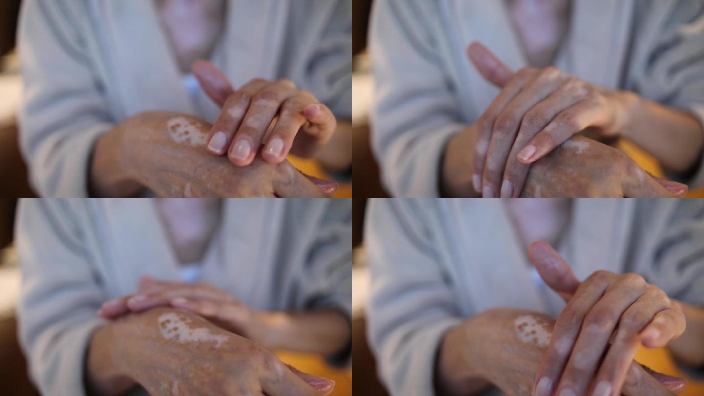 患有白癜风的老年妇女在手上涂抹保湿霜