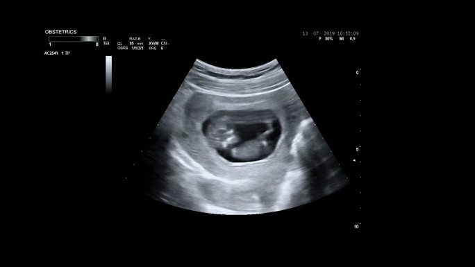 孕妇的超声波检查。