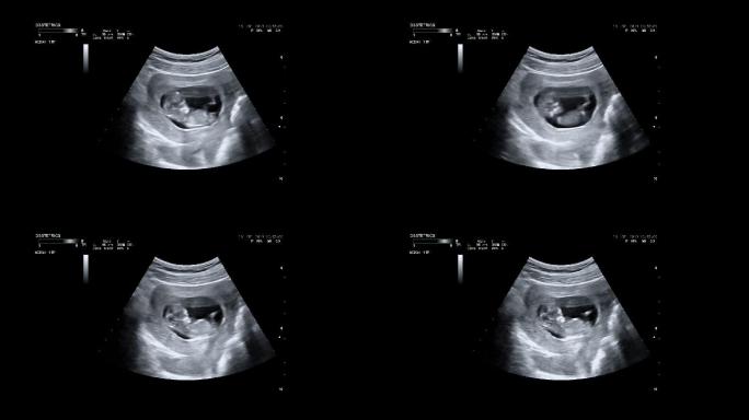 孕妇的超声波检查。