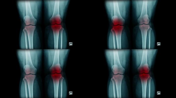 膝关节x线图像风湿病灶病痛风寒老寒腿