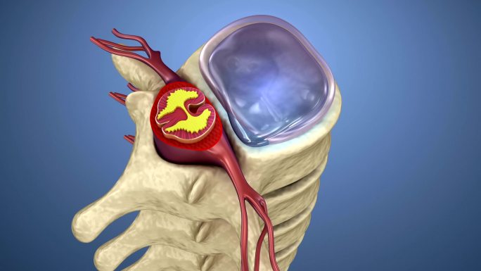 脊髓在椎间盘膨出的压力下3d动画