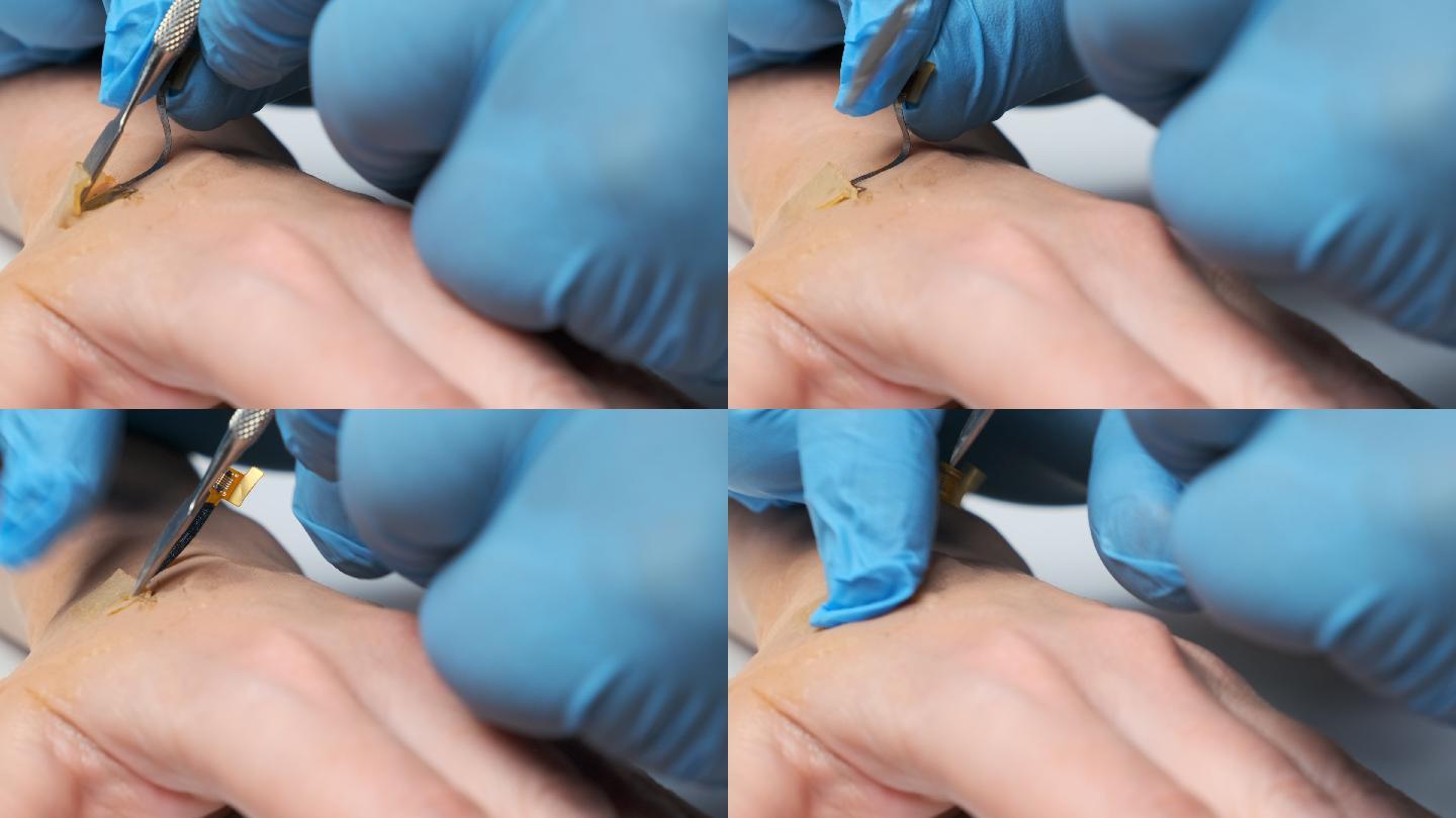 微芯片被植入人手皮肤下