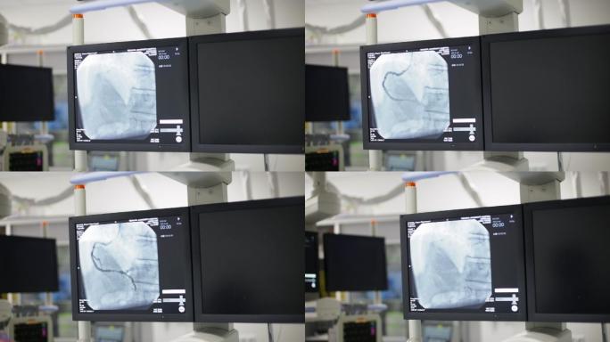 心脏手术中放射科的监视器屏幕