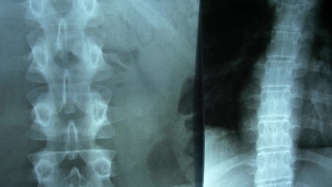 患者脊柱和胸部POV的X射线图像