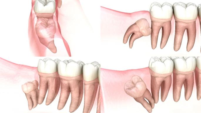 医学上精确的牙齿3D动画