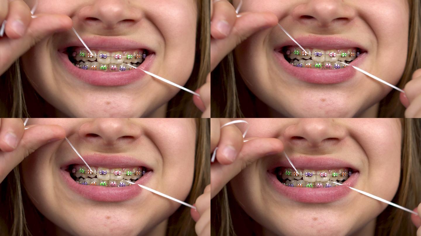 戴牙套的女孩用牙线刷牙特写