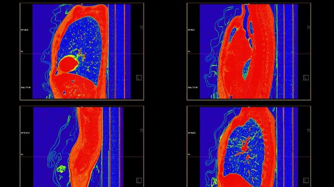 肺部疾病和冠状病毒的CT胸部造影