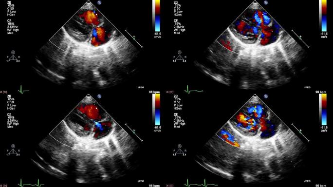 带有心脏图像的超声波机屏幕。