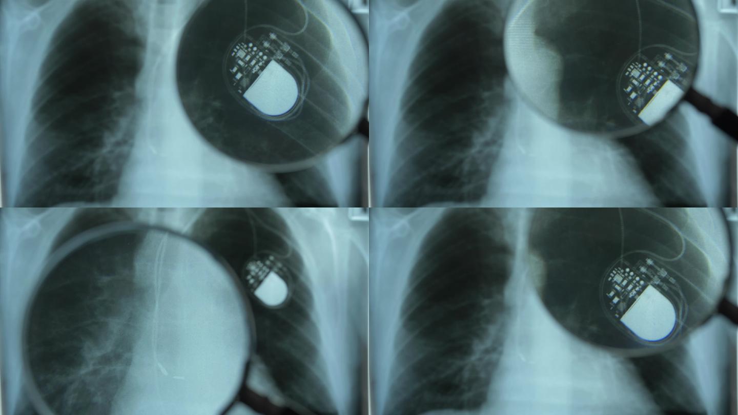 放大镜下人工心脏起搏器胸部X线图像