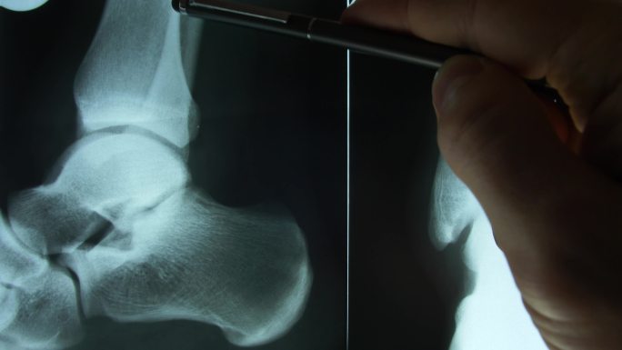 临床医生分析患者脚踝的X光图像