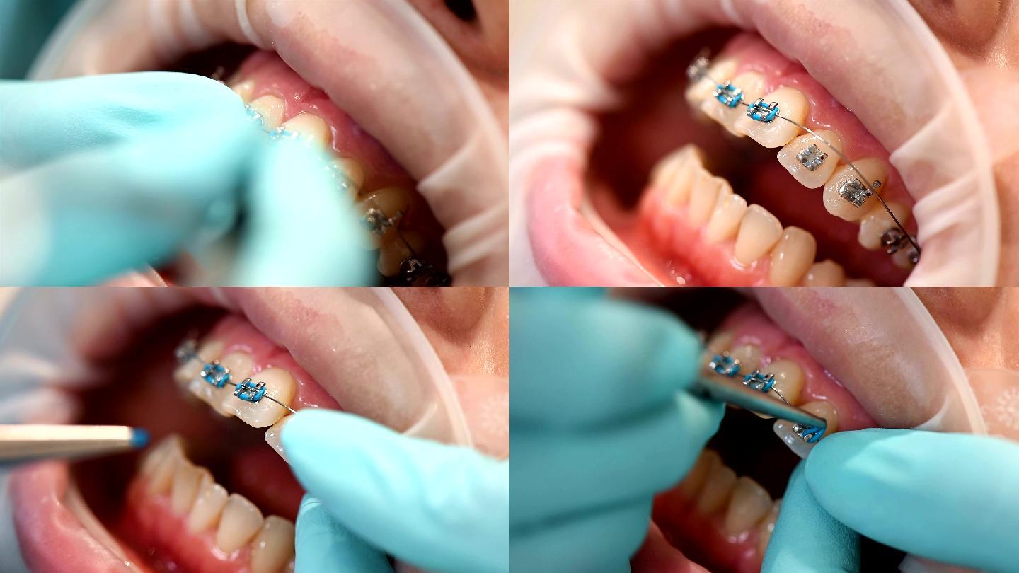 牙医给患者戴上牙套