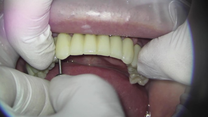 为患者在上颌安装金属塑料牙。