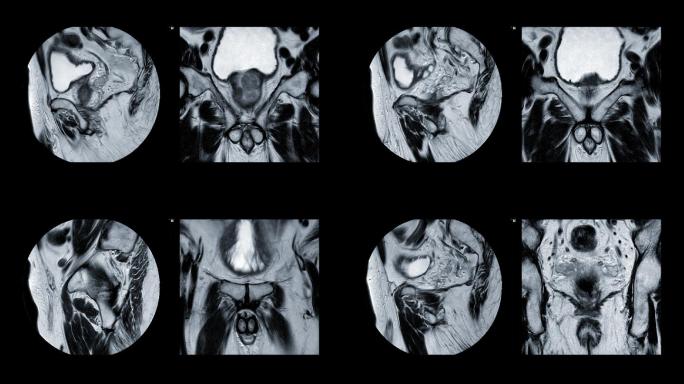 老年人前列腺癌的矢状位MRI诊断