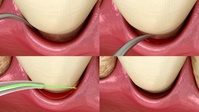 牙科治疗的医学精确牙齿3D动画