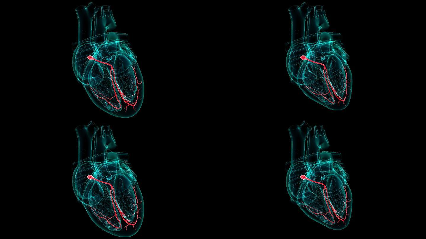 心脏人造起搏器3d医学视频素材