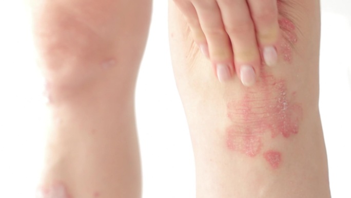 女性使用治疗软膏来缓解膝盖上的多发炎。
