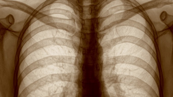 肺部疾病患者的X光胸片。