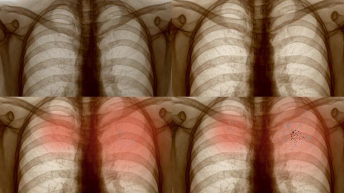 肺部疾病患者的X光胸片。