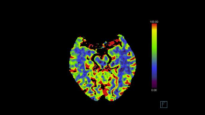 CT脑灌注研究成像系统核磁共振MRI