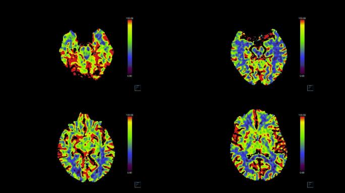 CT脑灌注研究成像系统核磁共振MRI
