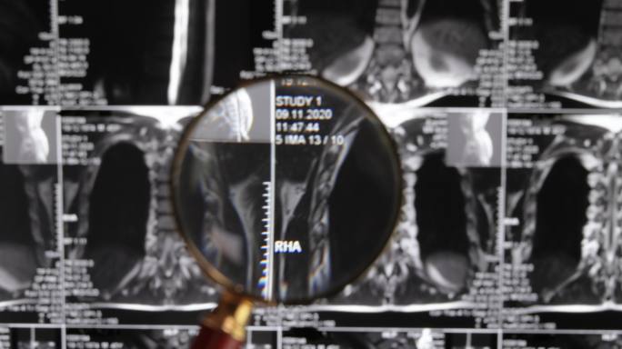医生检查脊椎和神经盘挤压的腰椎MRI。