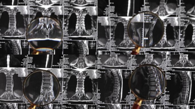 医生检查脊椎和神经盘挤压的腰椎MRI。