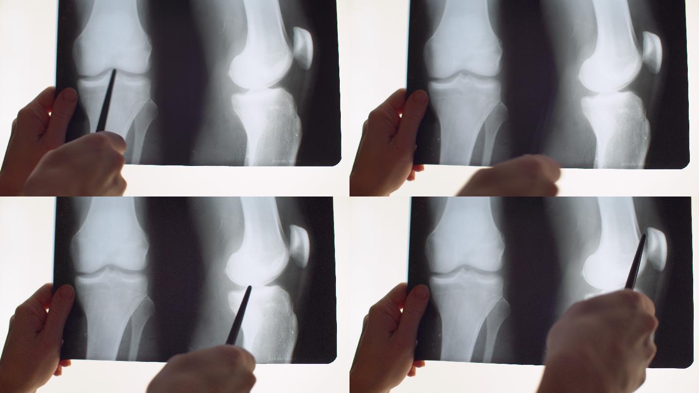 医生正在阅读患者的膝盖X线照片