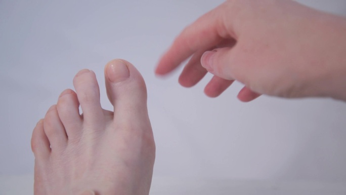 大脚趾畸形的初始程度。