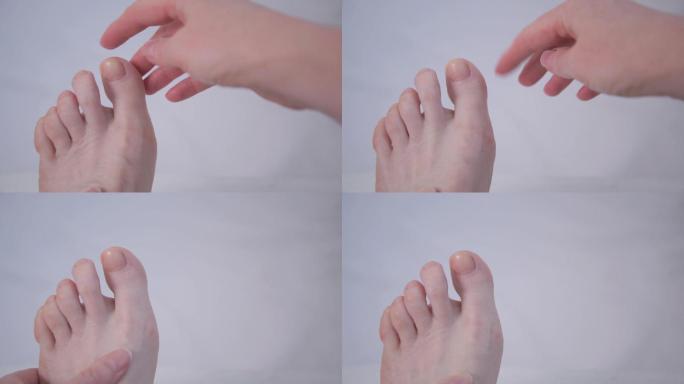 大脚趾畸形的初始程度。