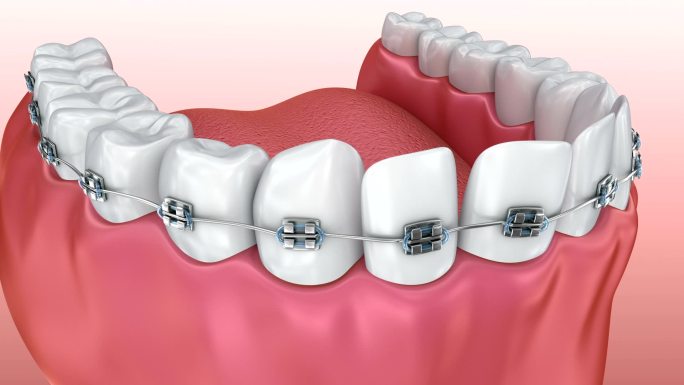 牙齿与牙套对齐的过程。