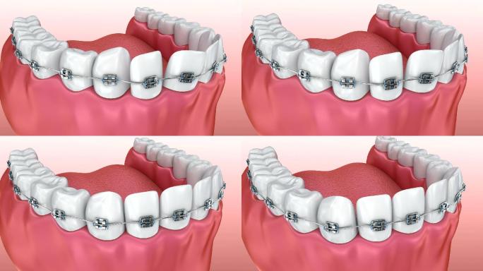 牙齿与牙套对齐的过程。