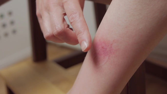 一个女人腿上被昆虫咬伤的特写镜头