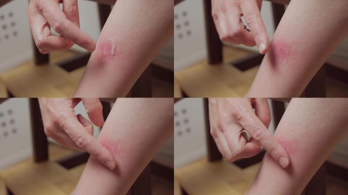 一个女人腿上被昆虫咬伤的特写镜头