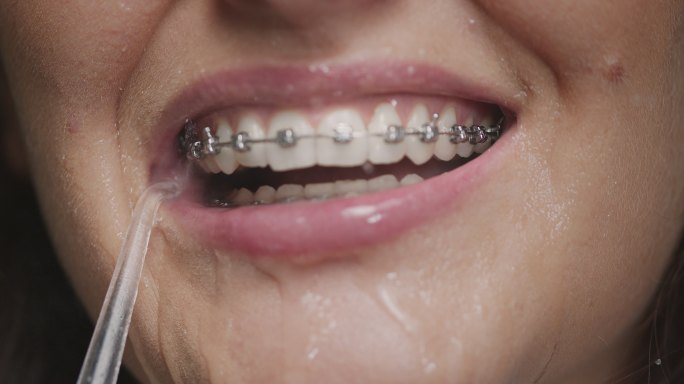 牙套护理，清洁口腔