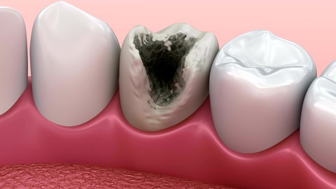 牙齿损坏3D动画。