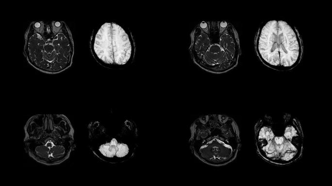 磁共振成像（MRI）上的CT脑扫描图像