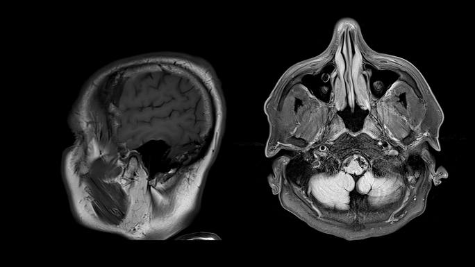 磁共振成像（MRI）上的CT脑扫描图像