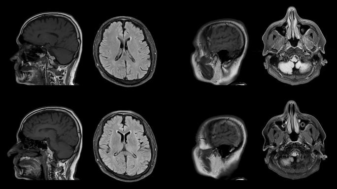 磁共振成像（MRI）上的CT脑扫描图像