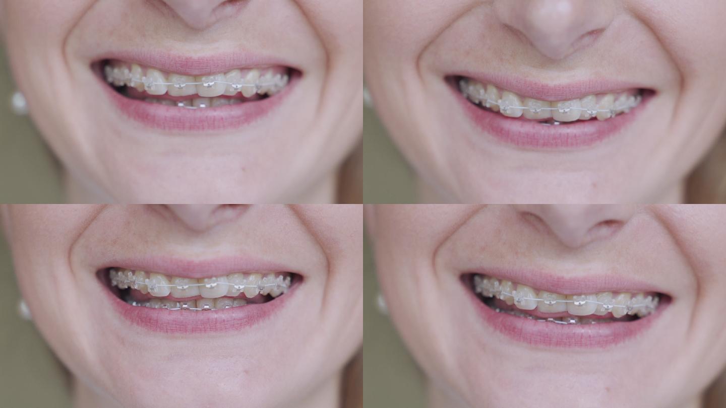 女孩微笑着露出牙齿上的牙套