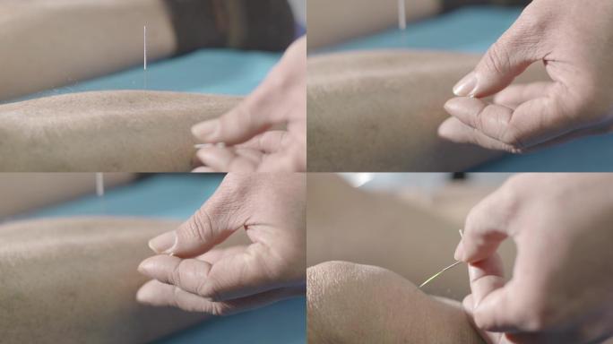 中医院风湿关节痛疼传统针灸扎针经络起针