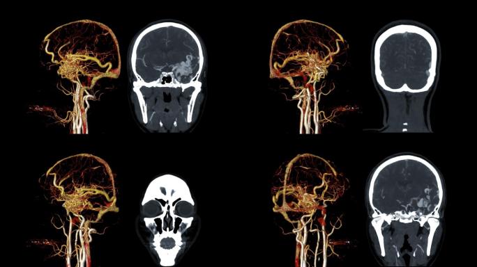 在屏幕上显示脑AVM或动静脉畸形。