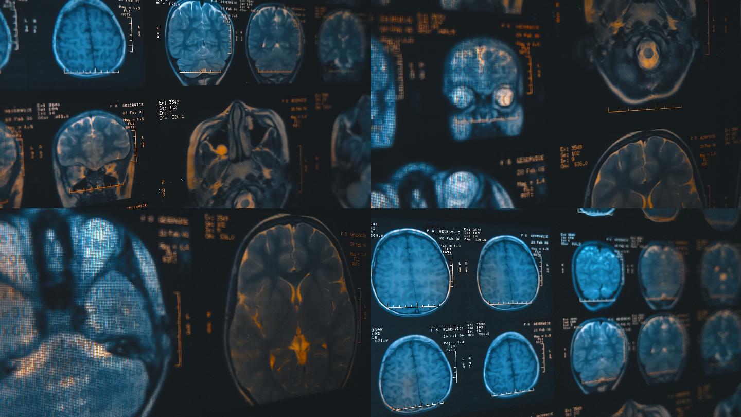 人类大脑的磁共振成像（mri）。