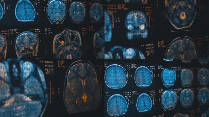 人类大脑的磁共振成像（mri）。